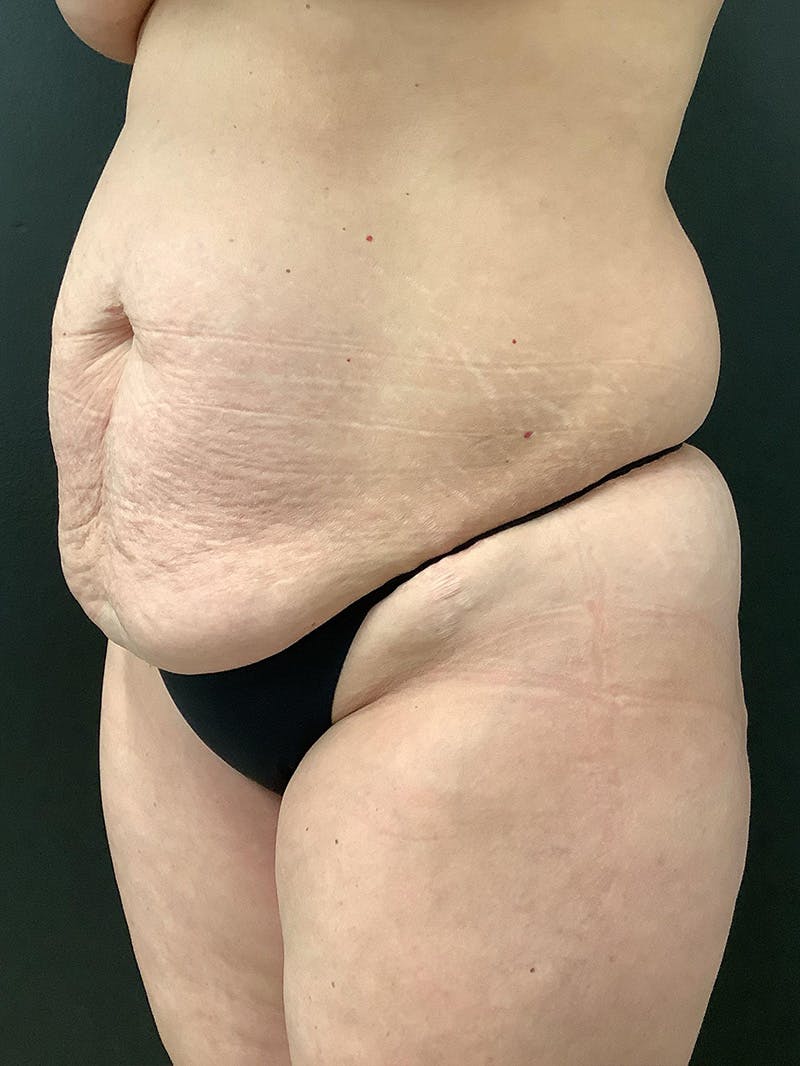 Abdominoplasty Before & After Gallery - Patient 311557 - Image 5