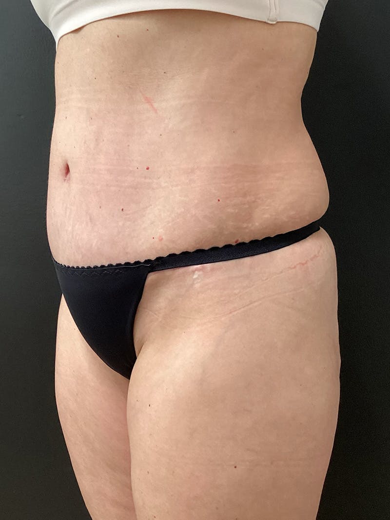 Abdominoplasty Before & After Gallery - Patient 311557 - Image 6