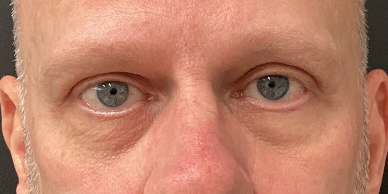 Eyelid Surgery Before & After Gallery - Patient 369179 - Image 2