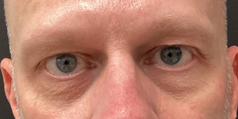 Eyelid Surgery Before & After Gallery - Patient 369179 - Image 1