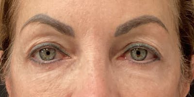 Eyelid Surgery Before & After Gallery - Patient 335301 - Image 1
