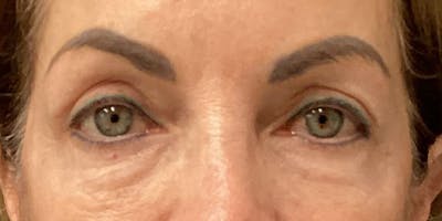 Eyelid Surgery Before & After Gallery - Patient 335301 - Image 2