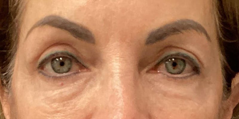Eyelid Surgery Before & After Gallery - Patient 335301 - Image 2