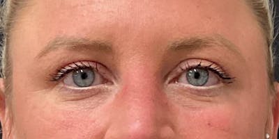 Eyelid Surgery Before & After Gallery - Patient 256095 - Image 2