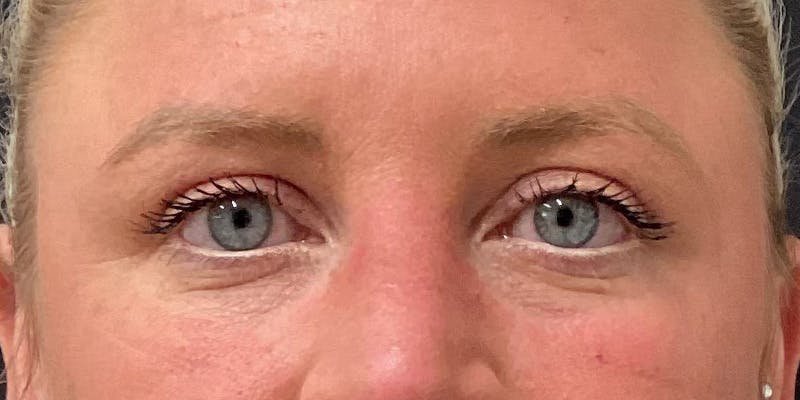 Eyelid Surgery Before & After Gallery - Patient 256095 - Image 2