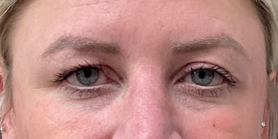 Eyelid Surgery Before & After Gallery - Patient 256095 - Image 1