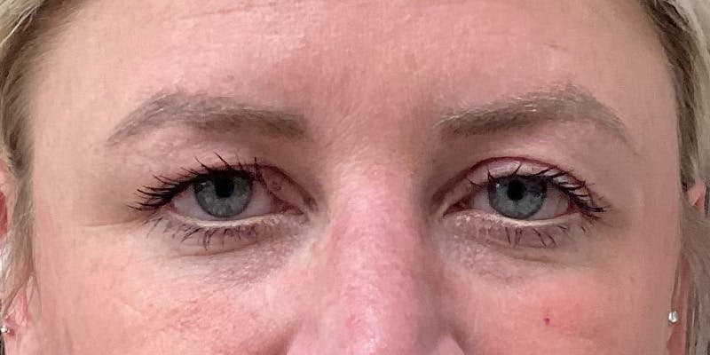 Eyelid Surgery Before & After Gallery - Patient 256095 - Image 1