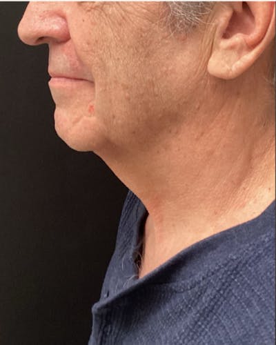 Facelift Before & After Gallery - Patient 220057 - Image 1