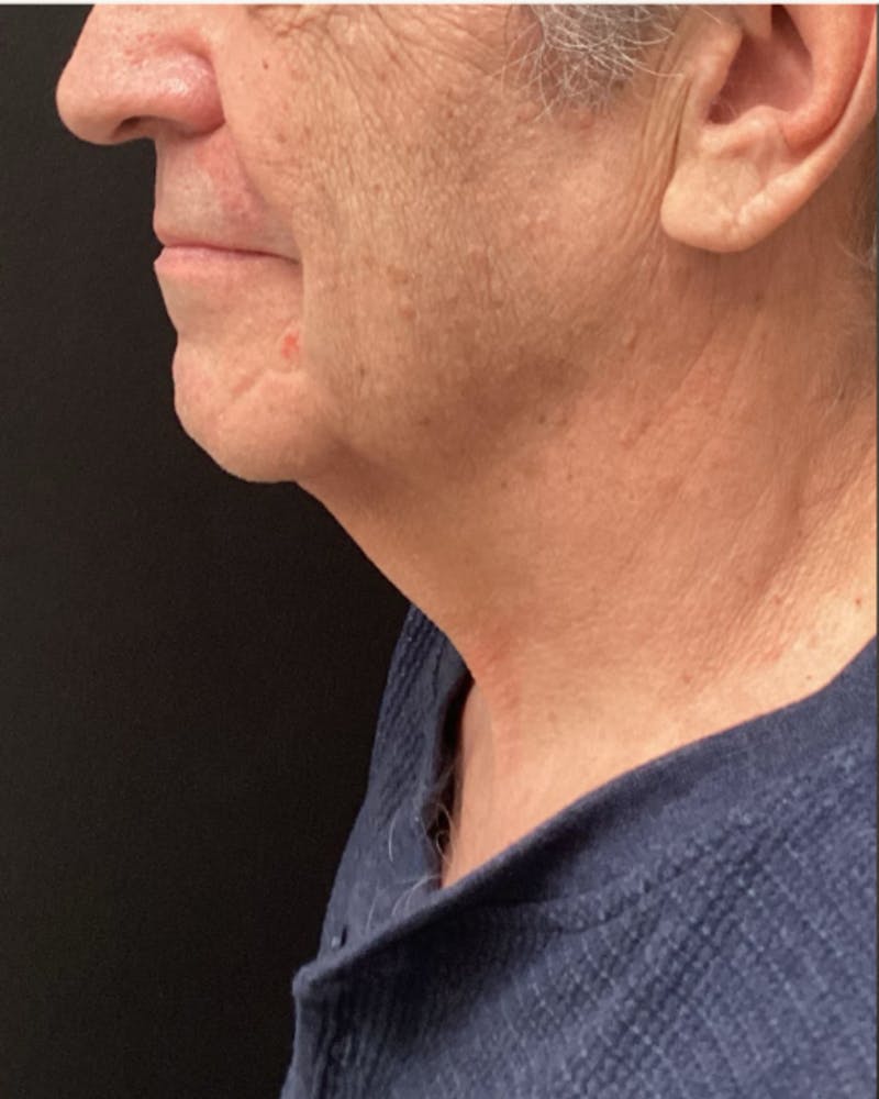Facelift Before & After Gallery - Patient 220057 - Image 1