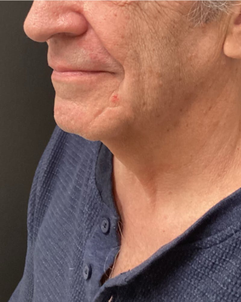 Facelift Before & After Gallery - Patient 220057 - Image 3