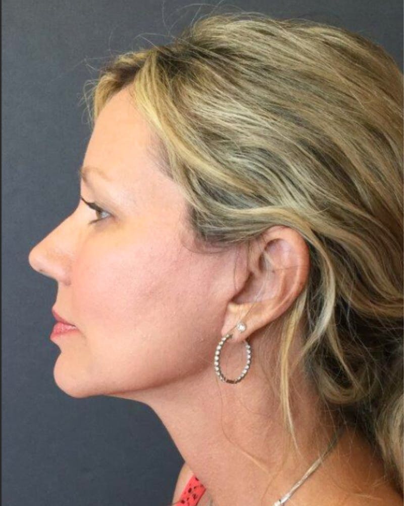 Facelift Before & After Gallery - Patient 181645 - Image 2
