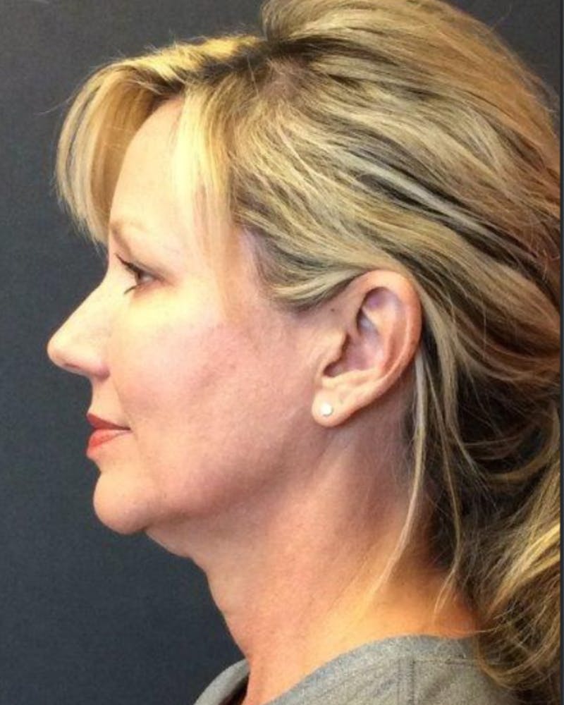 Facelift Before & After Gallery - Patient 181645 - Image 1
