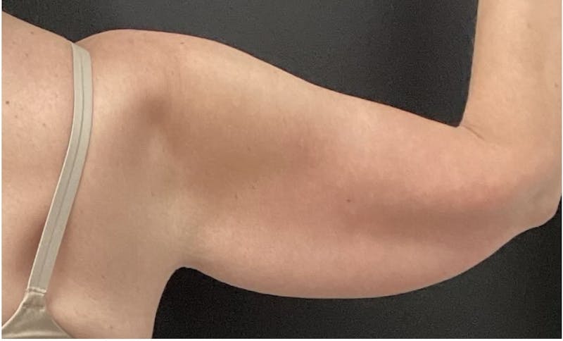 Arm Lift Before & After Gallery - Patient 280046 - Image 3