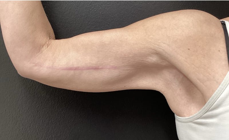 Arm Lift Before & After Gallery - Patient 280046 - Image 2