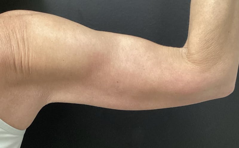 Arm Lift Before & After Gallery - Patient 280046 - Image 4