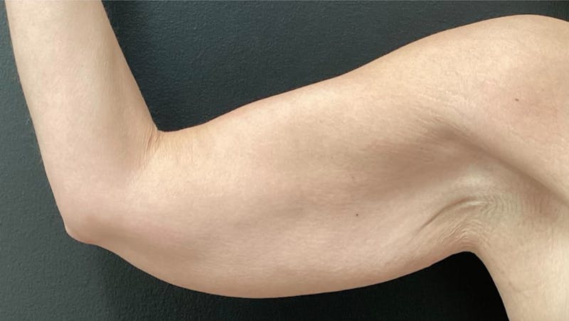 Arm Lift Before & After Gallery - Patient 280046 - Image 1