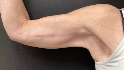 Arm Lift Before & After Gallery - Patient 280046 - Image 2