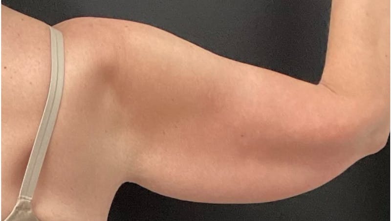 Arm Lift Before & After Gallery - Patient 280046 - Image 3