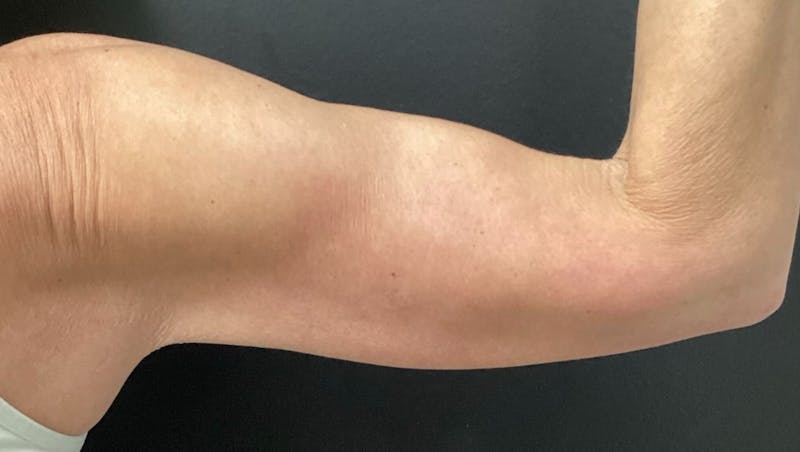 Arm Lift Before & After Gallery - Patient 280046 - Image 4