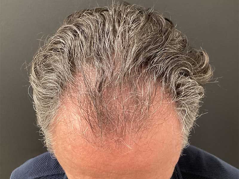 Hair Restoration Before & After Gallery - Patient 215290 - Image 3