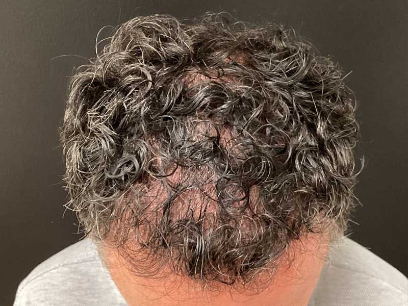 Hair Restoration Before & After Gallery - Patient 215290 - Image 4