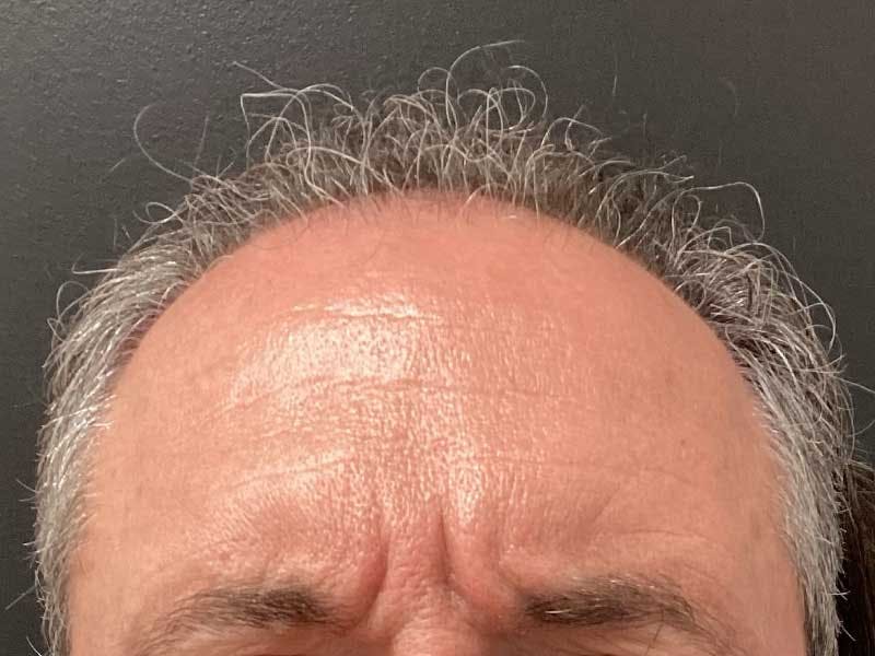 Hair Restoration Before & After Gallery - Patient 215290 - Image 1