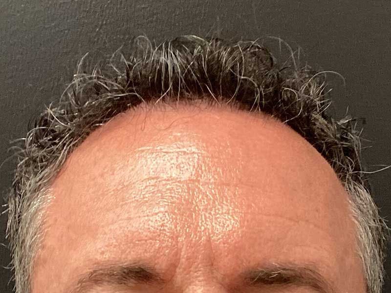 Hair Restoration Before & After Gallery - Patient 215290 - Image 2