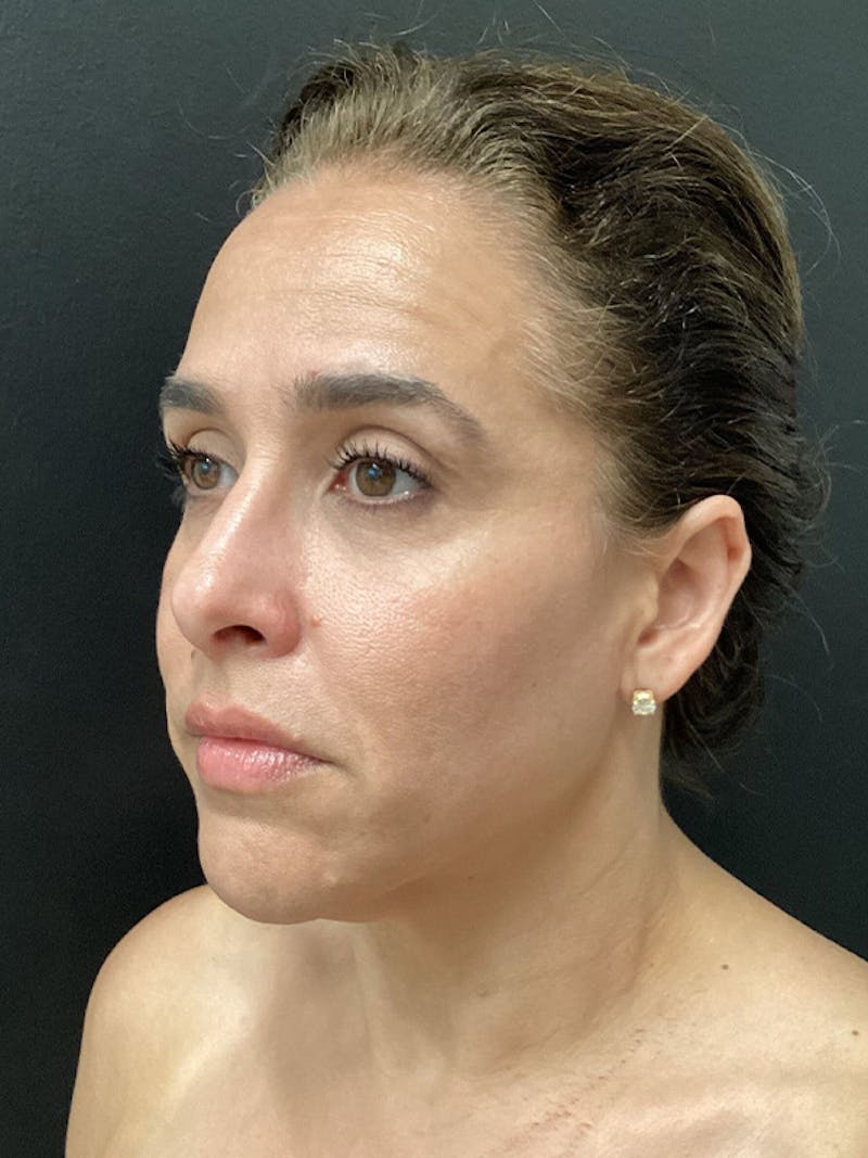 Facial Fat Transfer Before & After Gallery - Patient 165444 - Image 3