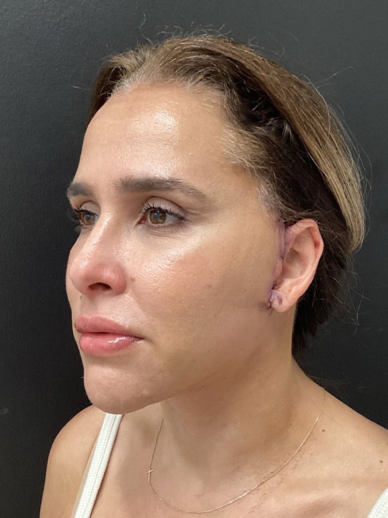 Facial Fat Transfer Before & After Gallery - Patient 165444 - Image 4