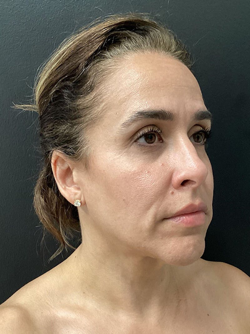 Facial Fat Transfer Before & After Gallery - Patient 165444 - Image 1