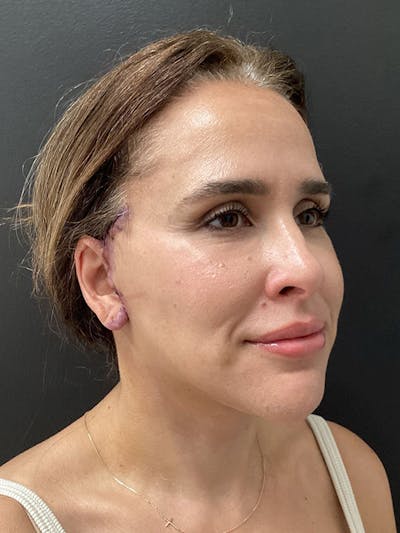 Facial Fat Transfer Before & After Gallery - Patient 165444 - Image 2