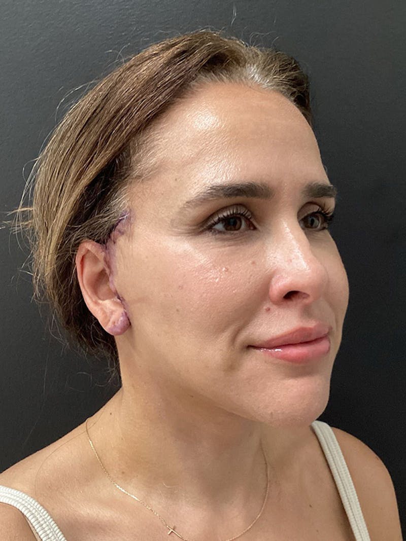 Facial Fat Transfer Before & After Gallery - Patient 165444 - Image 2