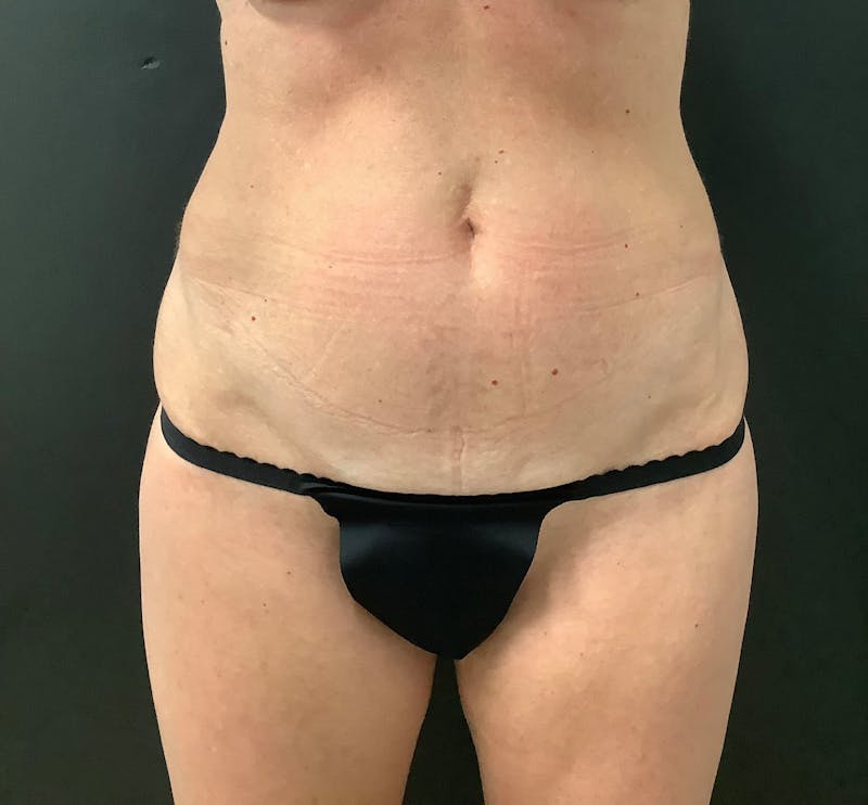 Liposuction Before & After Gallery - Patient 281863 - Image 1