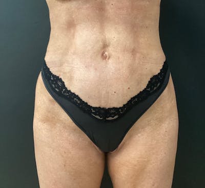 Liposuction Before & After Gallery - Patient 281863 - Image 2