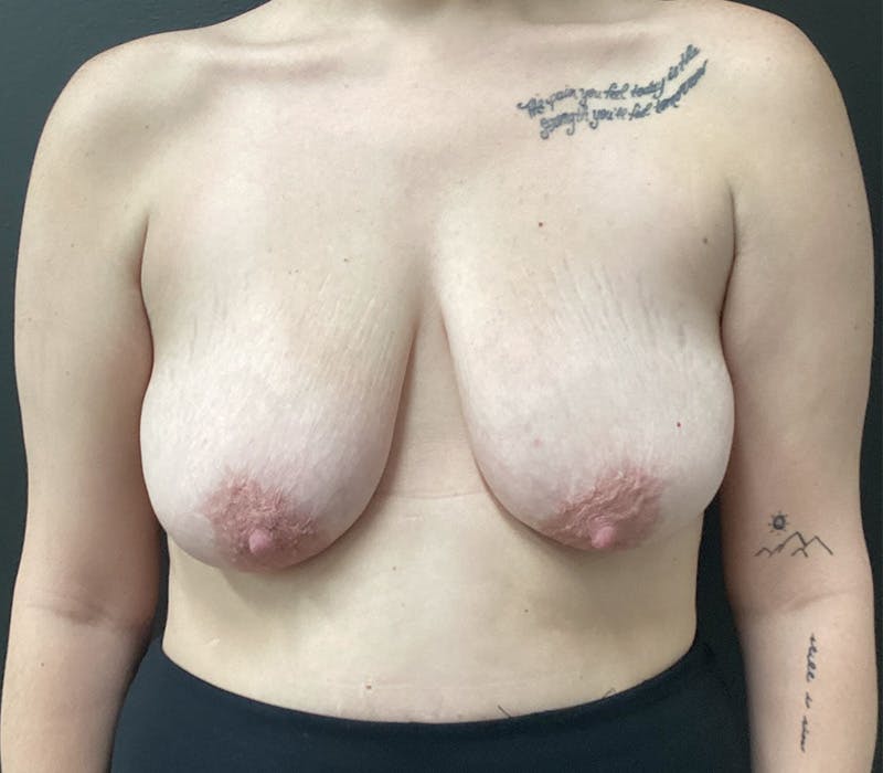 Breast Augmentation Before & After Gallery - Patient 179244 - Image 1