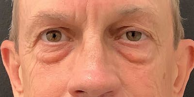 Eyelid Surgery Before & After Gallery - Patient 273502 - Image 1