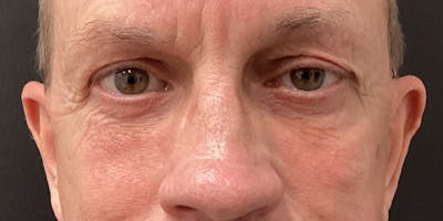Eyelid Surgery Before & After Gallery - Patient 273502 - Image 2