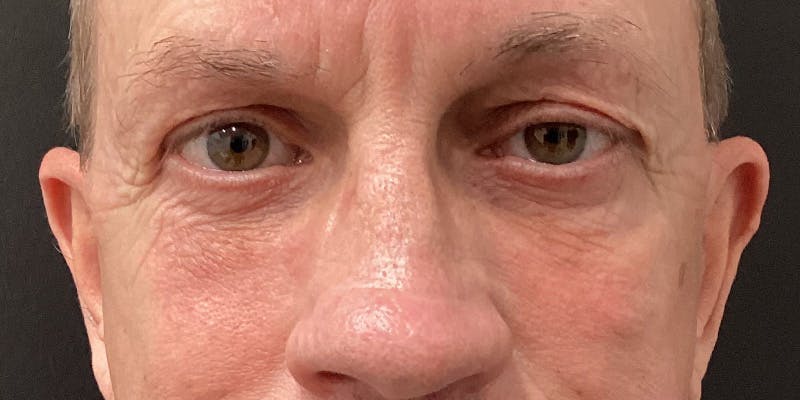 Eyelid Surgery Before & After Gallery - Patient 273502 - Image 2