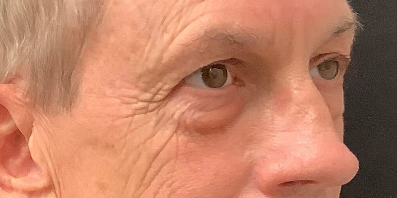 Eyelid Surgery Before & After Gallery - Patient 273502 - Image 3