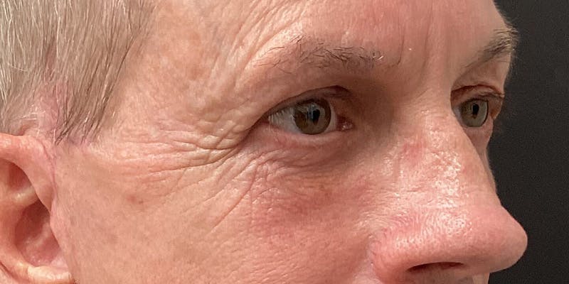 Eyelid Surgery Before & After Gallery - Patient 273502 - Image 4
