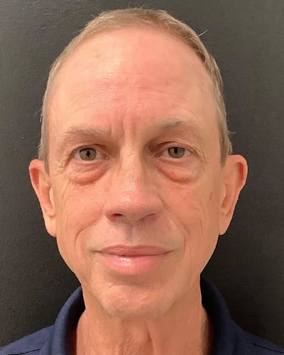 Facelift Before & After Gallery - Patient 157743 - Image 1