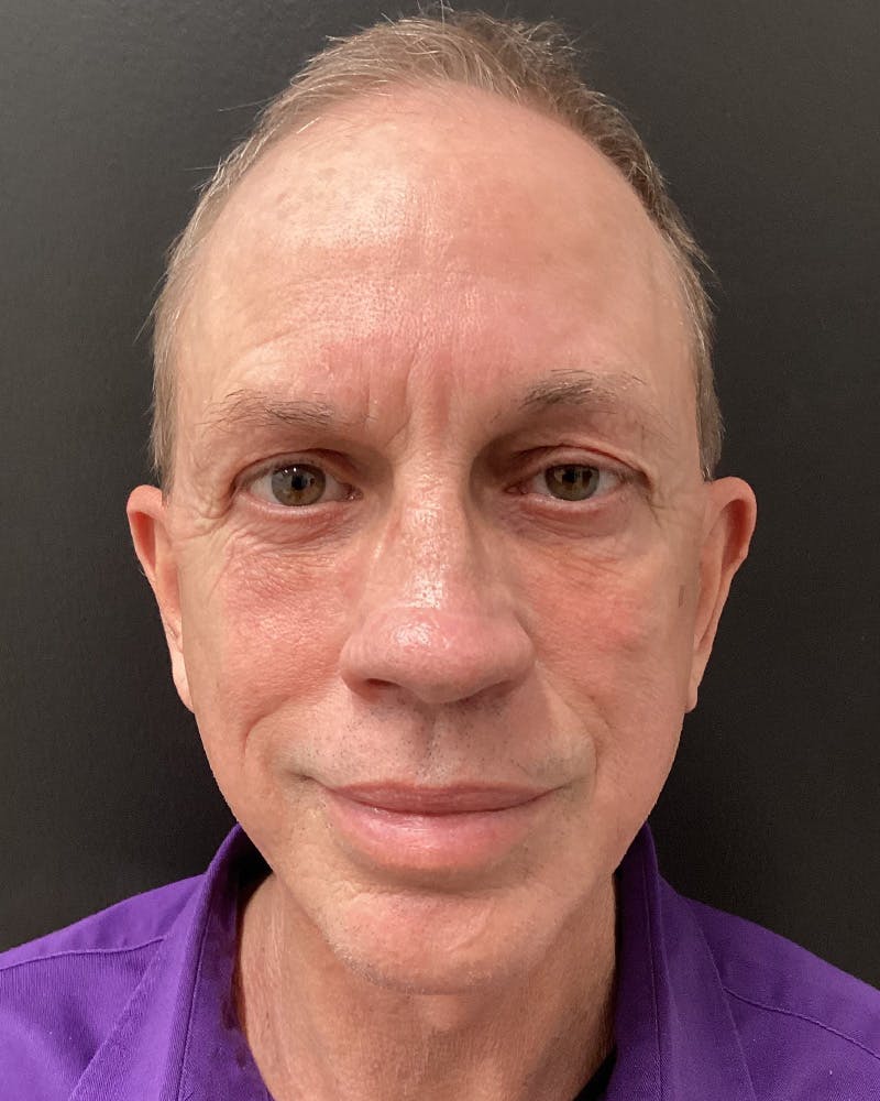 Facelift Before & After Gallery - Patient 157743 - Image 2