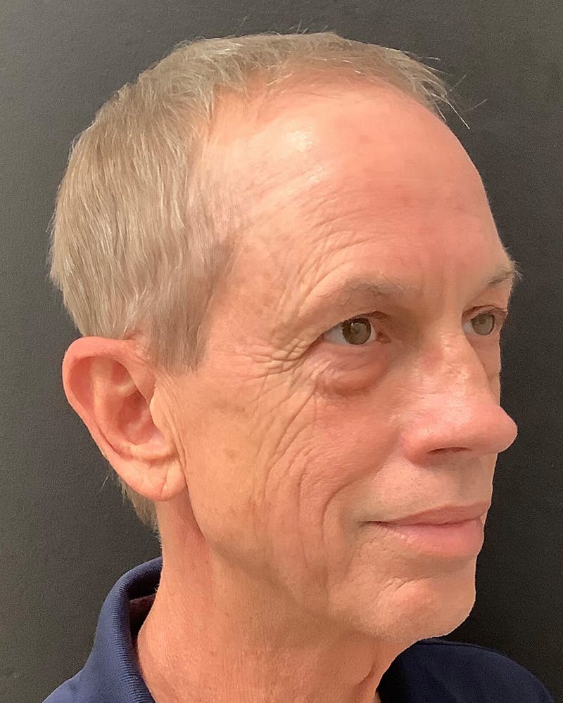 Facelift Before & After Gallery - Patient 157743 - Image 3