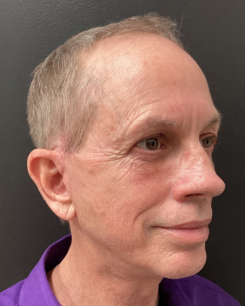 Facelift Before & After Gallery - Patient 157743 - Image 4