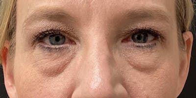 Eyelid Surgery Before & After Gallery - Patient 166060 - Image 1