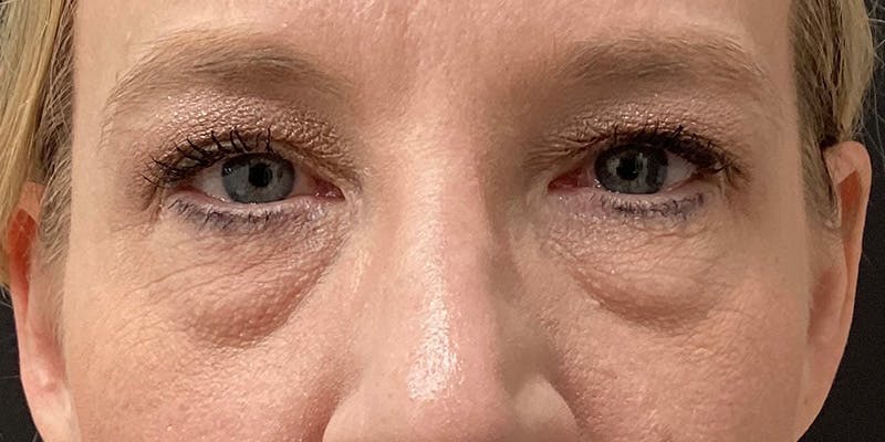 Eyelid Surgery Before & After Gallery - Patient 166060 - Image 1