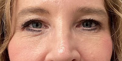 Eyelid Surgery Before & After Gallery - Patient 166060 - Image 2