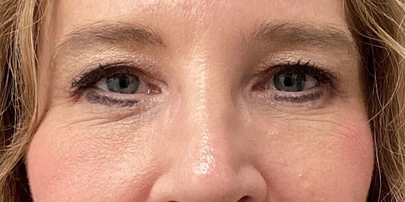 Eyelid Surgery Before & After Gallery - Patient 166060 - Image 2