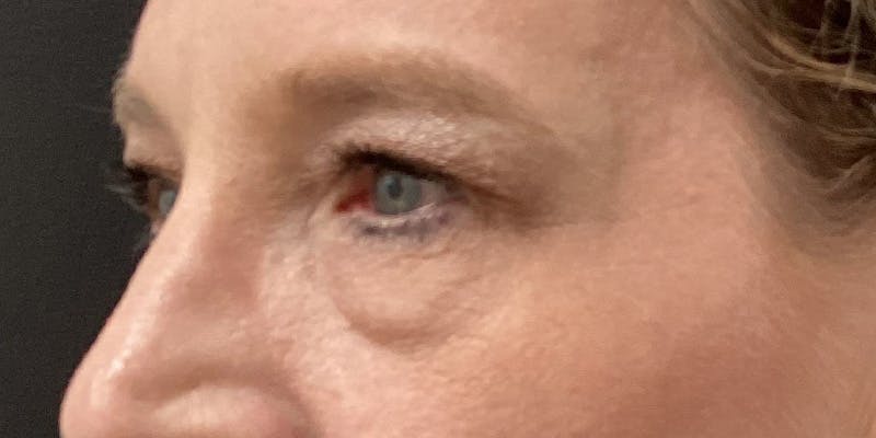Eyelid Surgery Before & After Gallery - Patient 166060 - Image 3