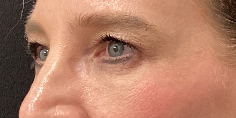 Eyelid Surgery Before & After Gallery - Patient 166060 - Image 4